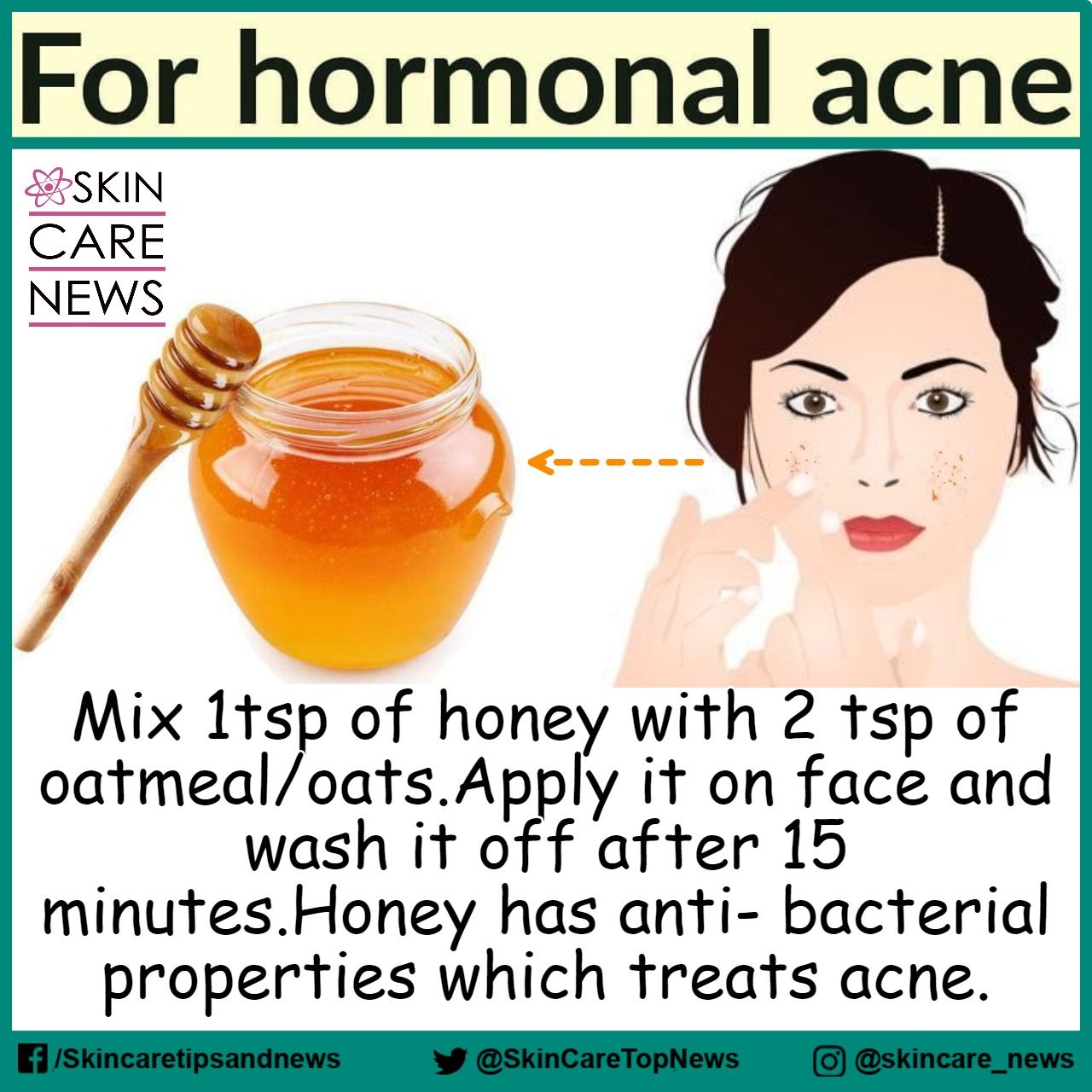 What is Hormonal Acne? Causes, Symptoms and Treatments