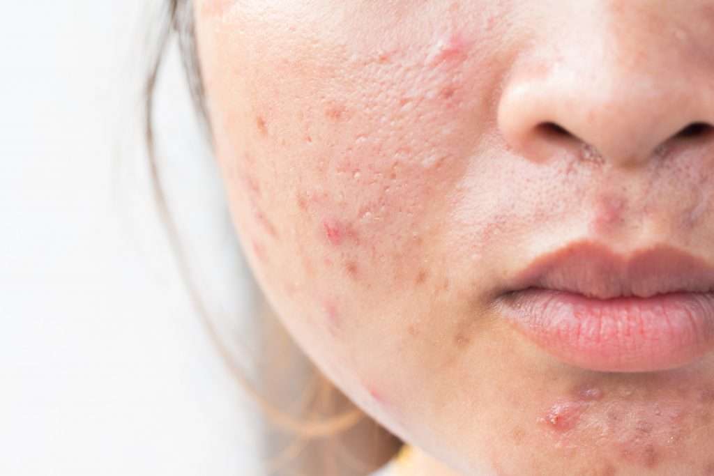 What Is The Best Acne Treatment For Dry Sensitive Skin?