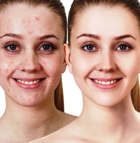 When does acne go away?