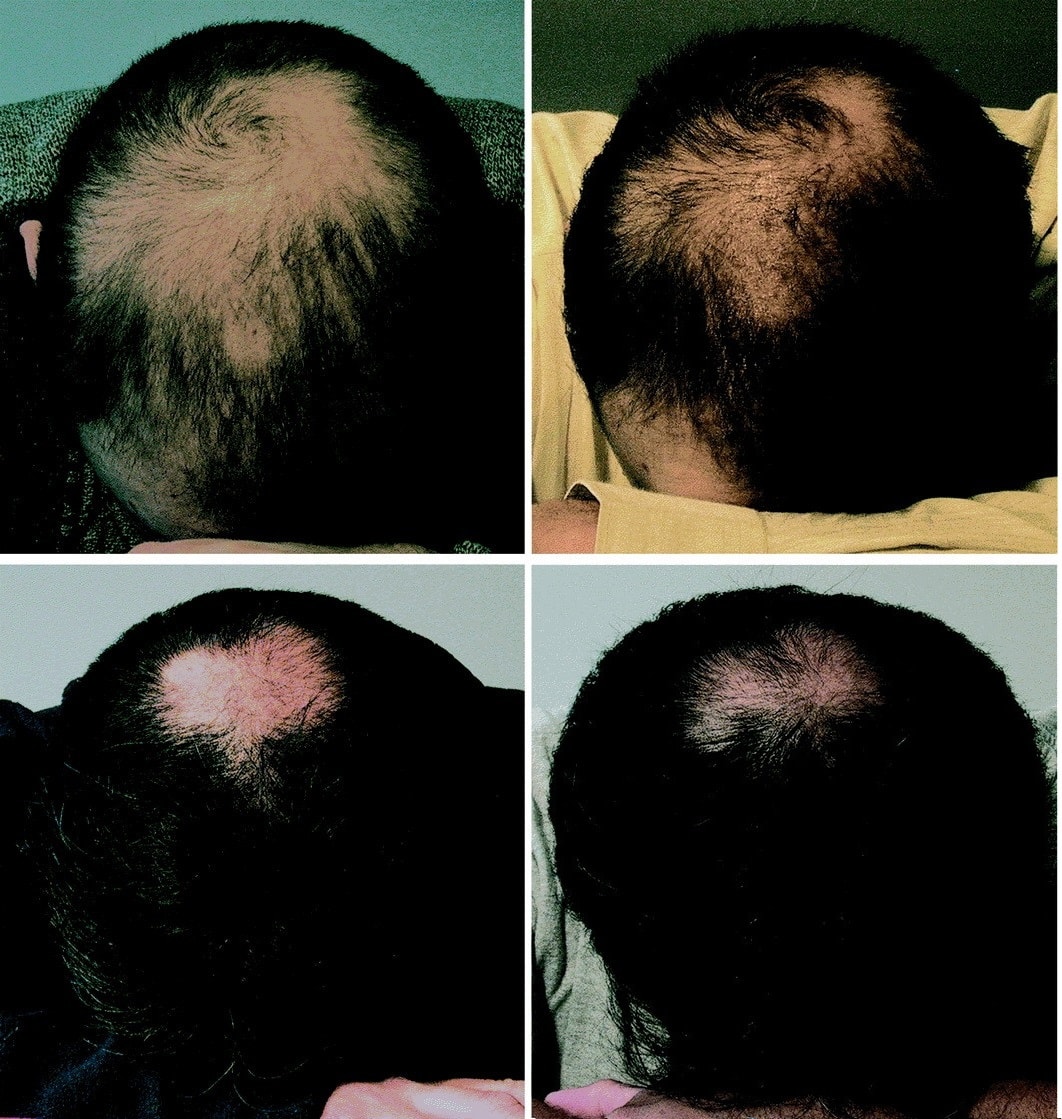 Will Hrt Help With Hair Loss : Transgender Hair Loss Treatments ...