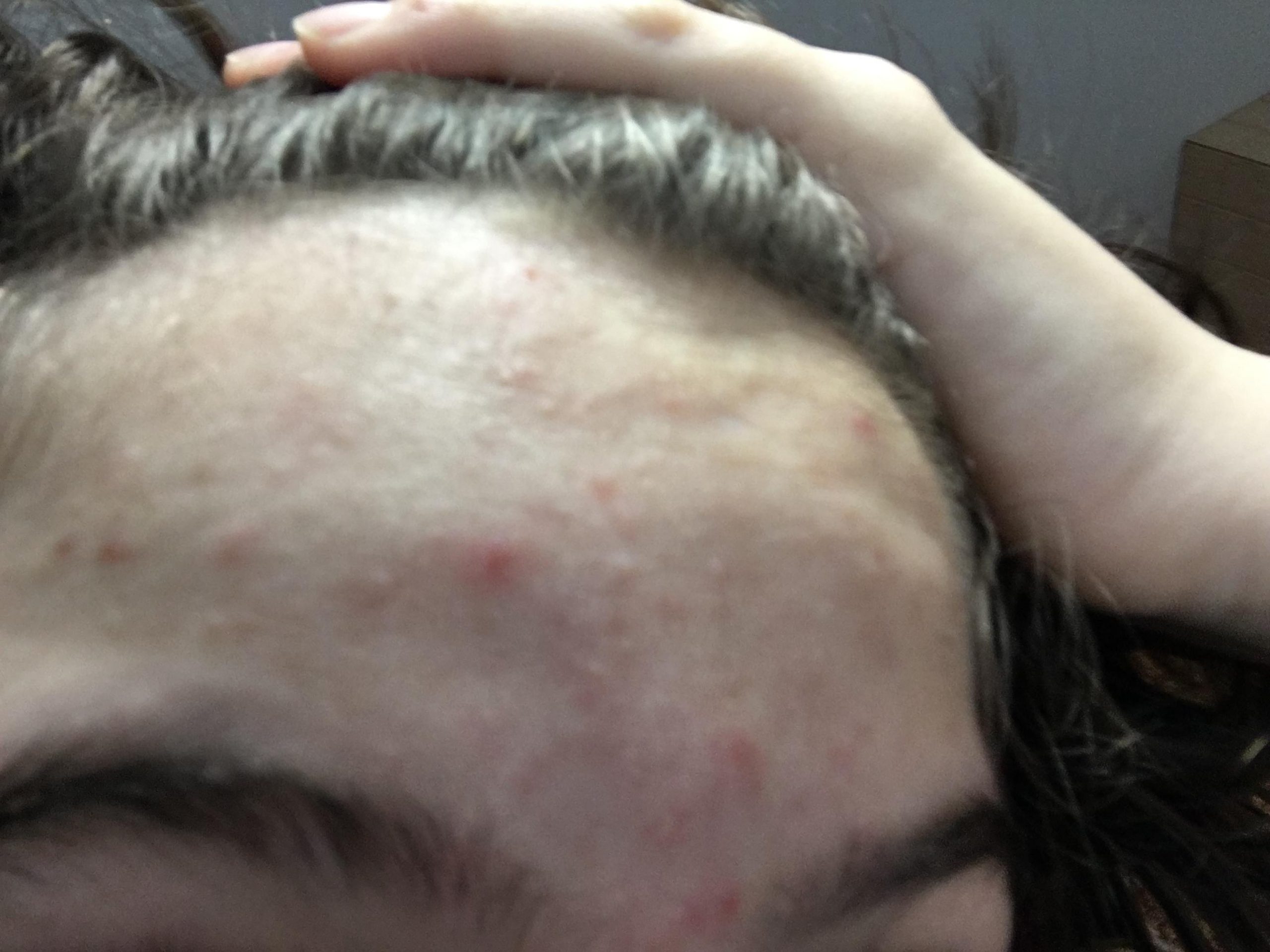 will my acne go away?