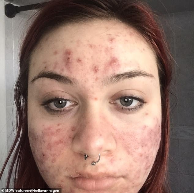 Woman whose cystic acne left her in