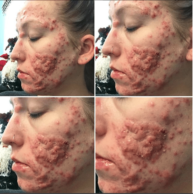 You gotta feel for this woman she developed bad Cystic Acne in her ...